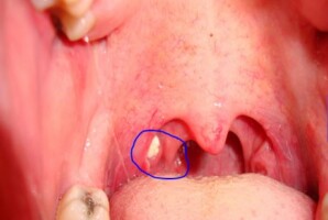 Are tonsil stones contagious