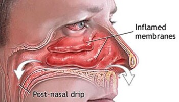 How do you clear a stuffy nose fast or instantly?