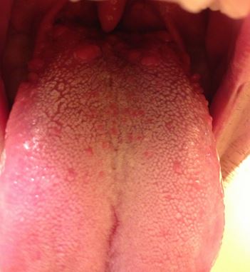 The back of tongue with enlarged taste buds