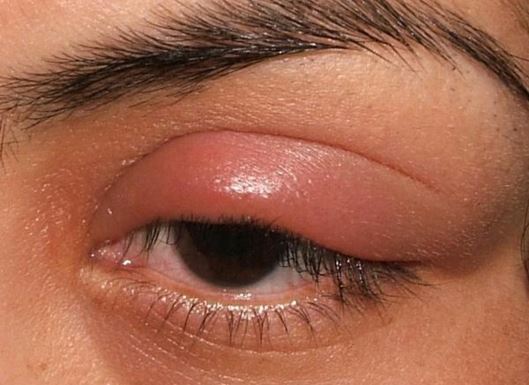 Swollen eyelid or stye