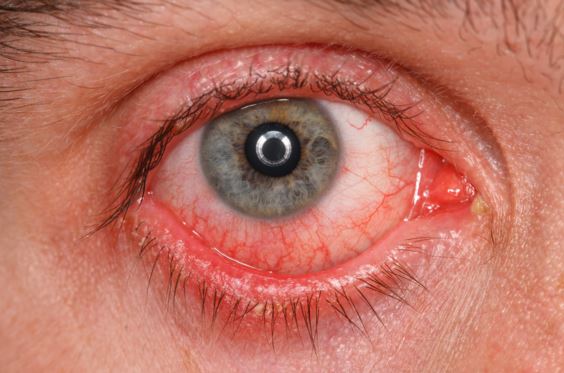 Viral conjunctivitis or pink eye 
