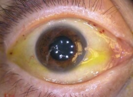 Eye discoloration and yellowing around eye whites