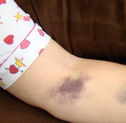 Bruised arm after IV, muscle twist