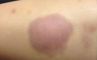 How to treat bruises if they are deep and severe