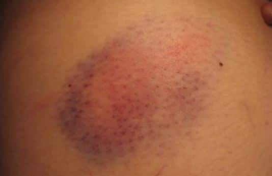 Mild bruise on skin - how to heal a bruise fast