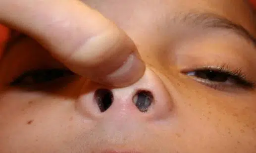 Nasal polyps or bump