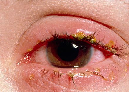 Allergic pink eye can be contagious