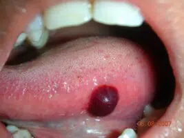 Blood blister on tongue - causes and treatment. Image source -