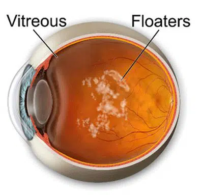 Do eye floaters go away? How do you remove them? Image courtesy of BerwickEye