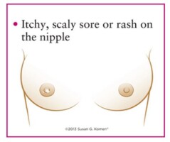 Pimple on nipple and cancer - image courtesy of the Susan G Komen organization