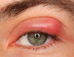 Swollen eyelid home remedies - you can get rid of swollen eyelid naturally at home