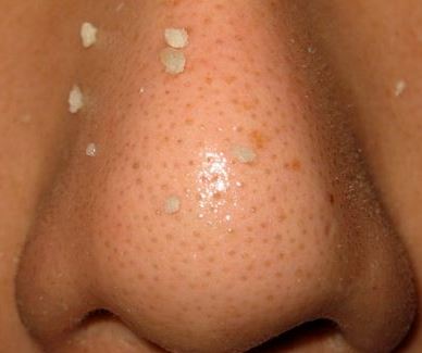 Sebaceous Filaments on Nose, Removal, How to Get Rid, Treatment to