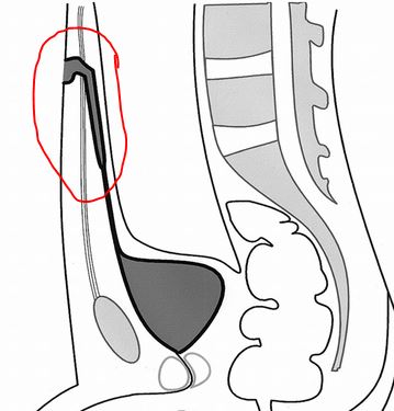 Umbilical urachal sinus. Image Source - Radiographics
