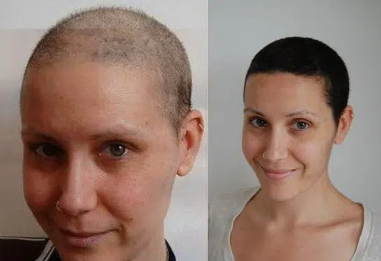 Hair growth after chemotherapy - image source - etopical