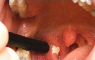 How to get rid of tonsil stones fast