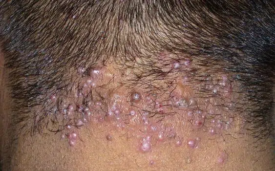 Pimple-like bumps on back of scalp of an adult