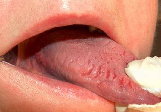 Tongue fissures, geographic tongue or cracked tongue may lead to sore taste buds