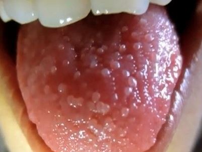 Transient Lingual Papillitis may cause swollen tongue and taste buds. Image courtey of medicalpoint org