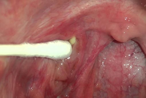 Use a q-tip, finger or bobby pin to remove tonsil stones that are visible in yoru throat