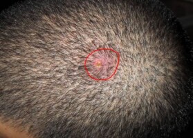 small red pimple can be painful on your scalp