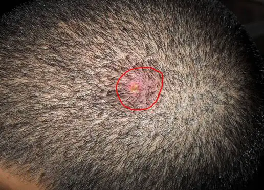 small red pimple can be painful on your scalp