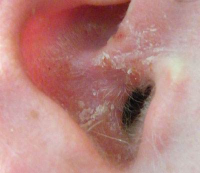 Scab in ear could be psoriasis
