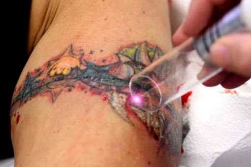 Laser tattoo removal can end up with an infection if the aftercare is poor.