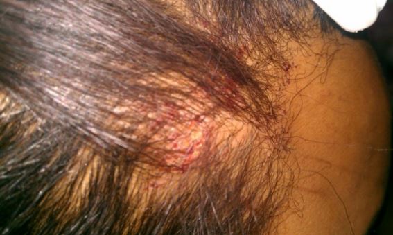 Red scabbing on scalp