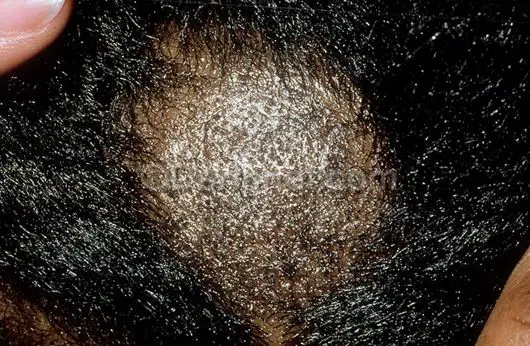 Ringworm on the scalp - Image Source - Dermnet