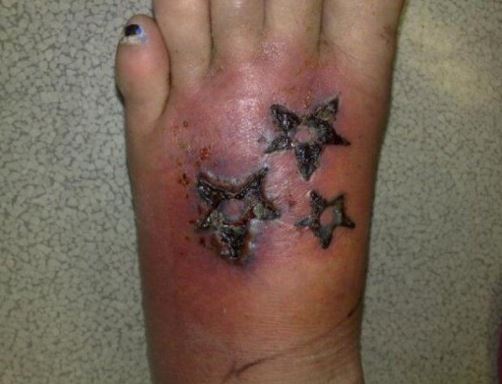 MRSA staph Tattoo infection on the leg