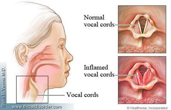 Inflamed vocal cords from singing, shouting