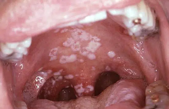 Oral thrush symptoms may also include the need to cough more often