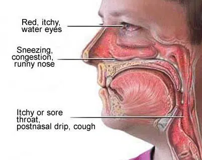 Postnasal drip and symptoms associated with the itchy throat irritation