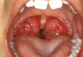 Throat infections such as tonsillitis can cause a scratchy throat