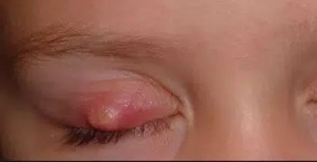 White bump on eyelid or Yellow stye spot on upper eyelid