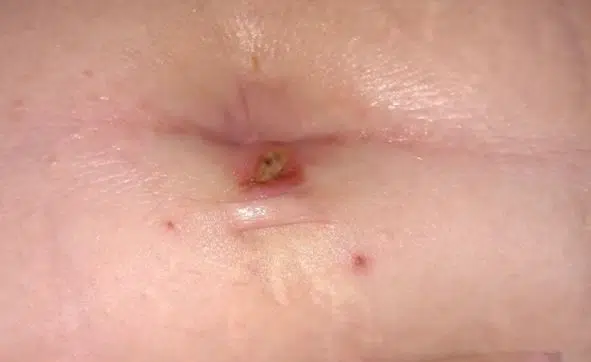 Belly button pain from infection