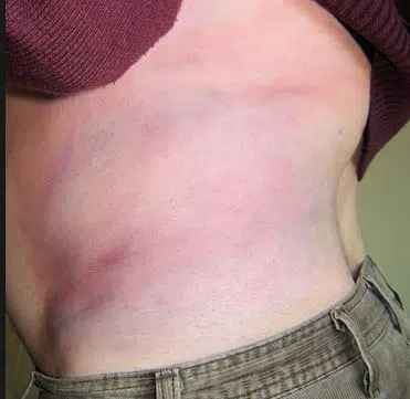 Bruised ribs