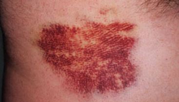Discolored skin due to bruising