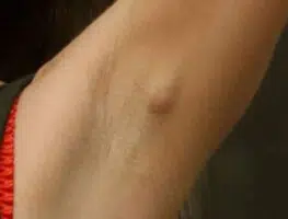 Movable armpit lump or lump in armpit