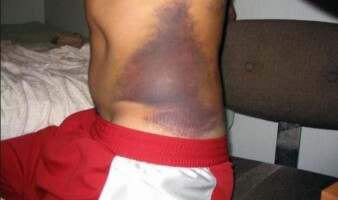 Severe bruises on sides could also mean a fractured rib