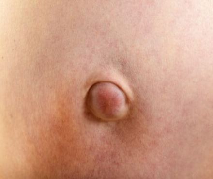 Umbilical hernia can be painful