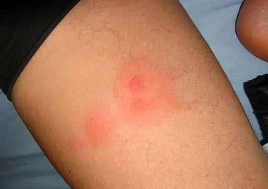 Bed bug bites vs. flea bites