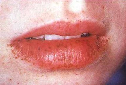 Dark freckles on lips