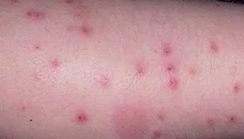 Flea bites on humans ankles and legs