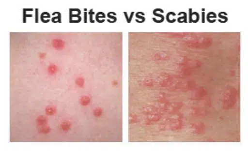 Flea bites vs scabies