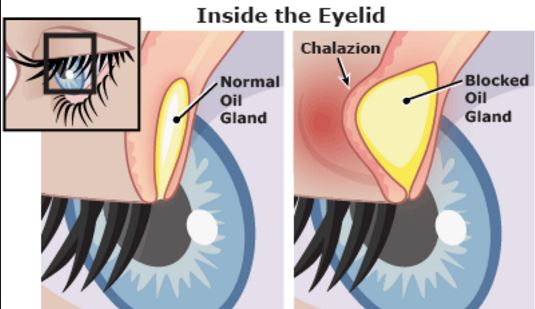 How a chalazion forms on the inside of eyelid