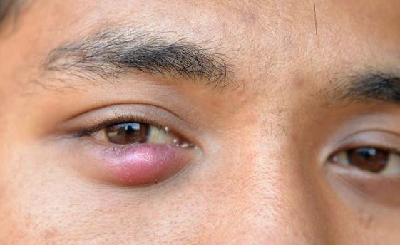 Lump under eyelid or pimple under eyelid