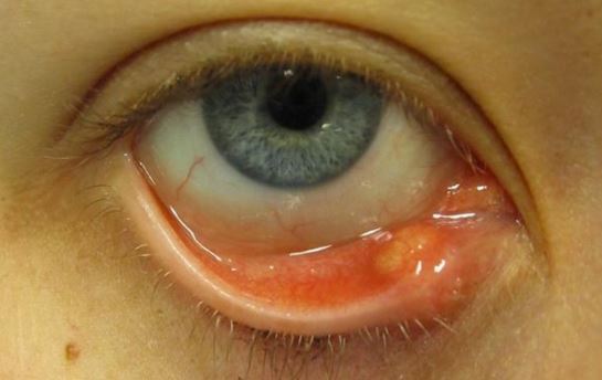 Pimple or bump inside eyelid