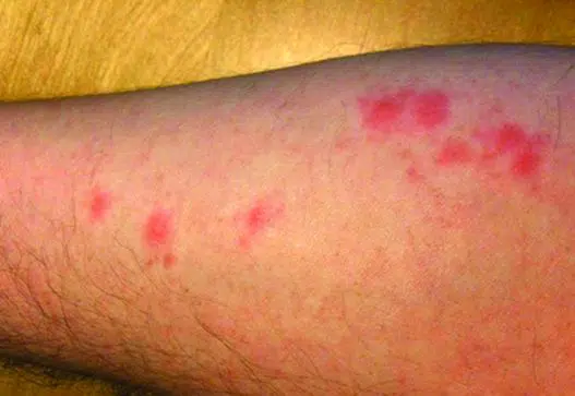 Red bed bug bite bumps