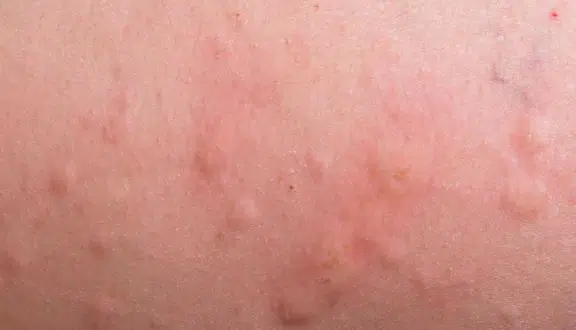Symptoms of flea bites on skin